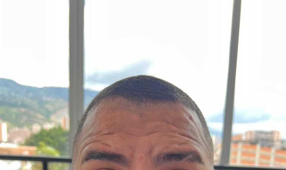 Arrugas de expresión antes del Botox en Belle Aesthetic