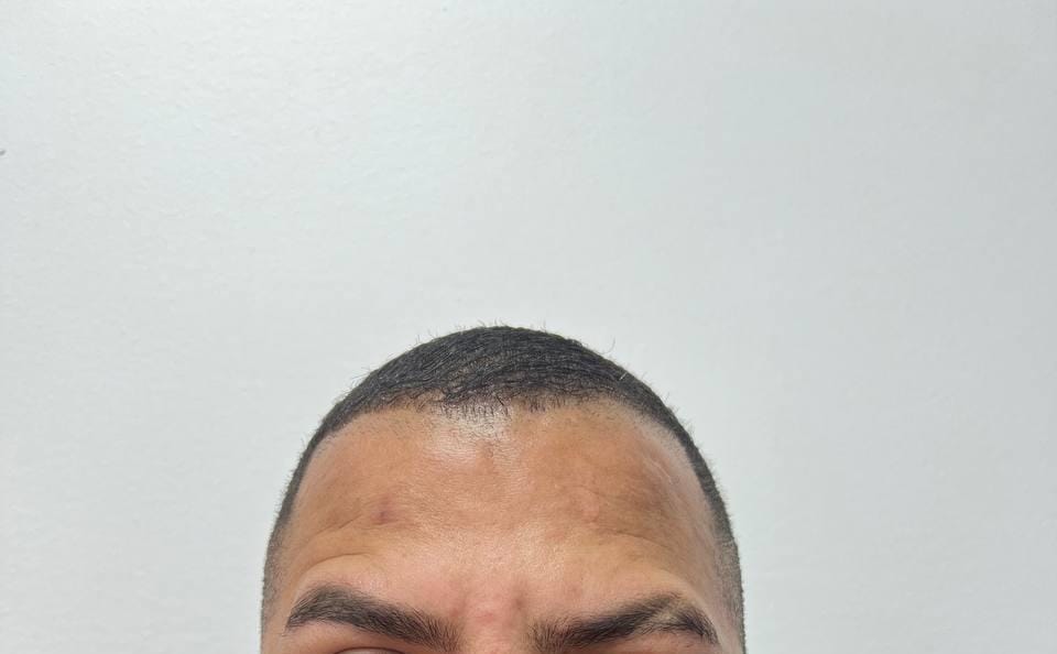 Resultado después de la aplicación de Botox (Toxina Botulínica) en Medellín