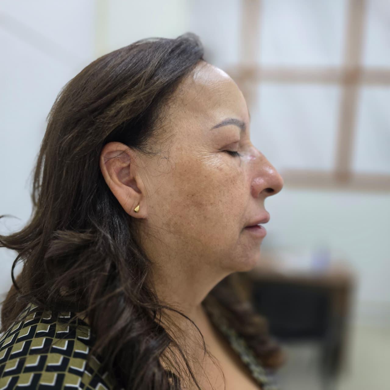 Resultado después del tratamiento facial para manchas en Belle Aesthetic Medellín